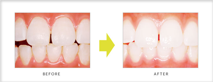トリートメントケアの効果[ホワイトニング患者さんの場合]